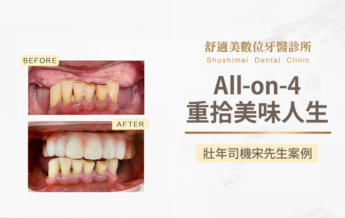 舒適美數位牙醫診所_All-on-4 案例分享：壯年司機一日重建，重拾美味人生