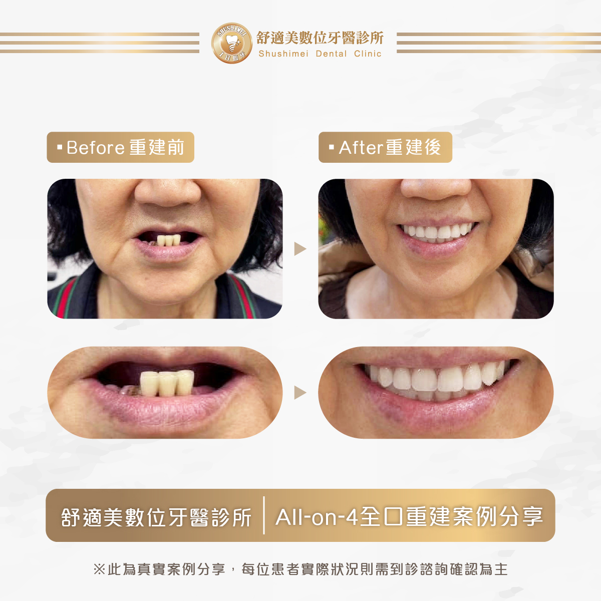舒適美牙科時事_植牙前我該注意什麼？一次看懂術前準備與評估重點