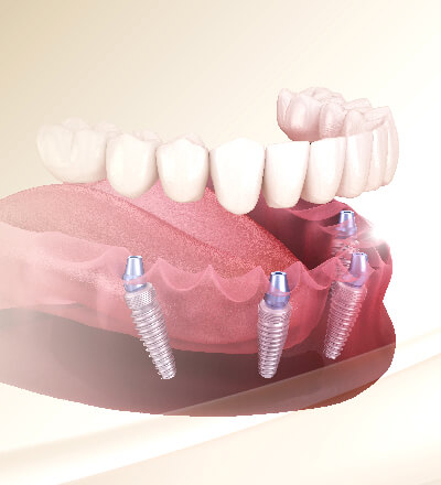 舒適美數位牙醫診所_一日全口重建 一日全口重建